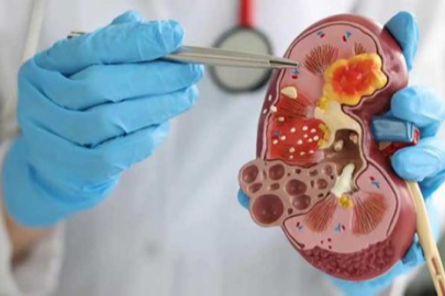 Böbrek taşı neden oluşur ve nasıl tedavi edilir?